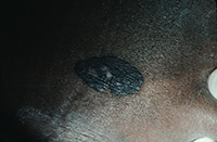 Bowenoid papulosis (Variant of squamous cell carcinoma in situ)